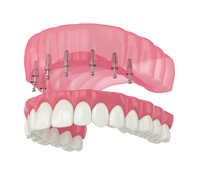 OverDenture